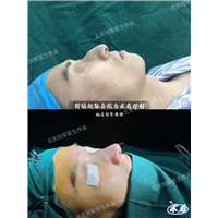 北京鼻部整形修复价格