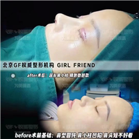 隆鼻不想用自己的肋软骨怎么办？