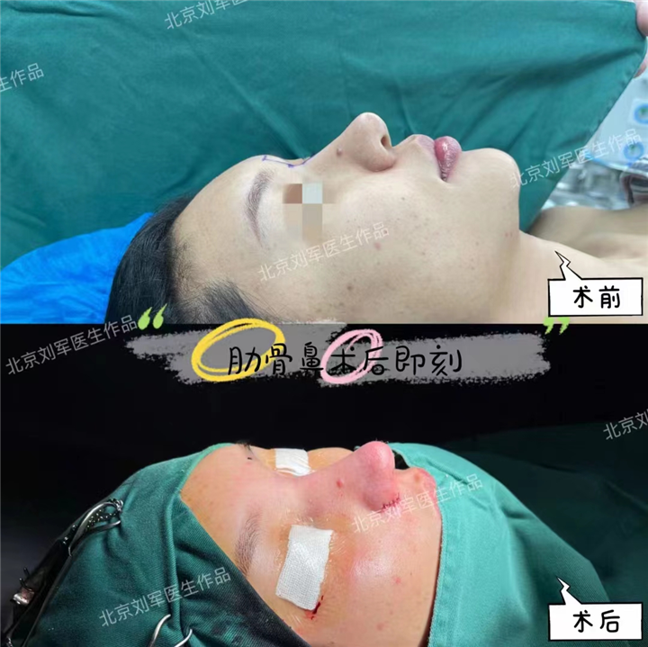 北京高难度鼻修复专家