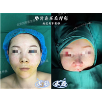北京鼻修复整形医生