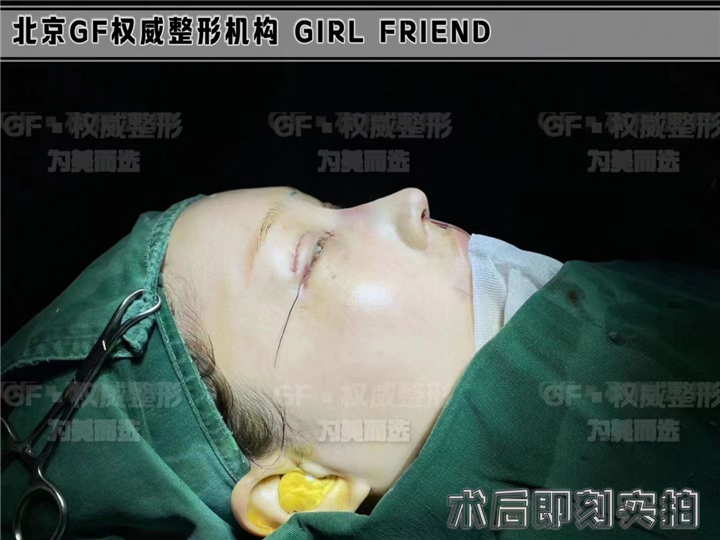 自体软骨隆鼻都会吸收吗？
