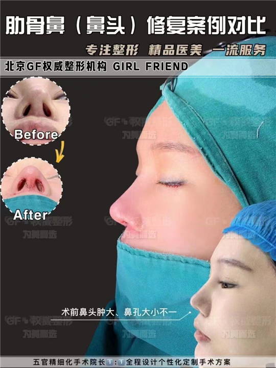 刘军整形医生；为什么建议填充鼻基底选择膨体？