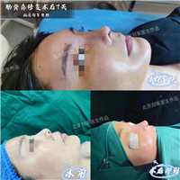 北京做鼻子的**专家