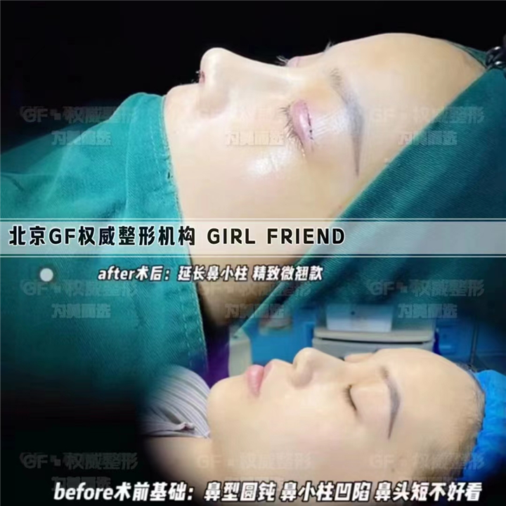 隆鼻不想用自己的肋软骨怎么办？