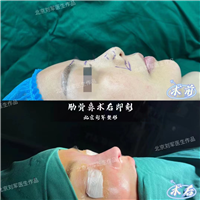 北京鼻修复整形医生