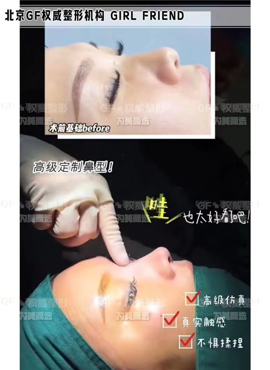 刘军医生鼻整形