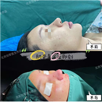 北京高难度鼻修复专家