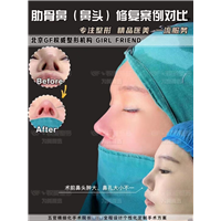 刘军整形医生；为什么建议填充鼻基底选择膨体？
