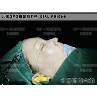 自体软骨隆鼻都会吸收吗？