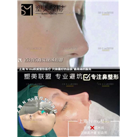 上海肋骨鼻修复价格