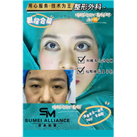 上海双眼皮去眼袋整形