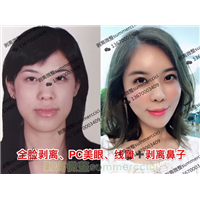 印第安纹去除方法|印第安纹价格