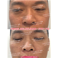 印第安纹剥离1次后效果 