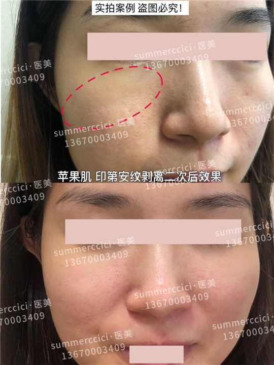 印第安纹苹果肌剥离2次后 