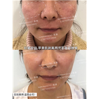 印第安纹苹果肌剥离半年后 