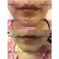 嘴角凹陷剥离后 