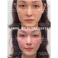 鼻基底剥离即刻效果 