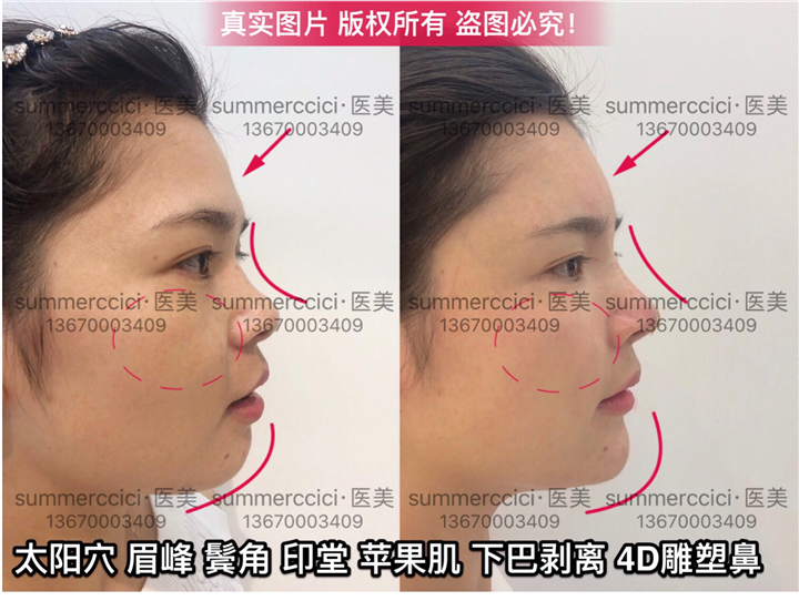 全脸剥离即刻效果 