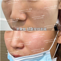 苹果肌印第安纹剥离 