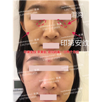 印第安纹剥离1次后效果 