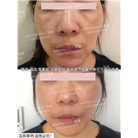 印第安纹苹果肌泪沟剥离一年多效果 