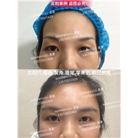 太阳穴眉峰剥离半年 