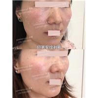 印第安纹剥离效果 