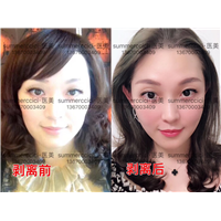 全脸剥离4年 