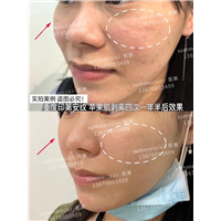 印第安纹剥离一年半效果 
