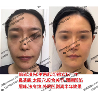 印第安纹剥离1年后效果 