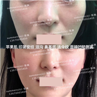 印第安纹剥离3次后效果 