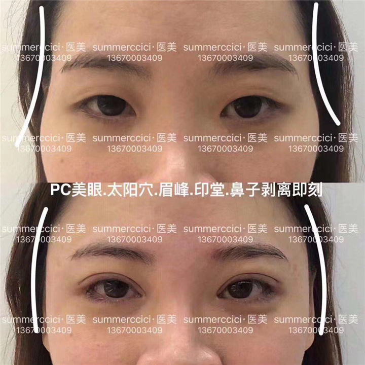 太阳穴眉峰印堂剥离即刻 