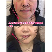 嘴角凹陷剥离后效果 