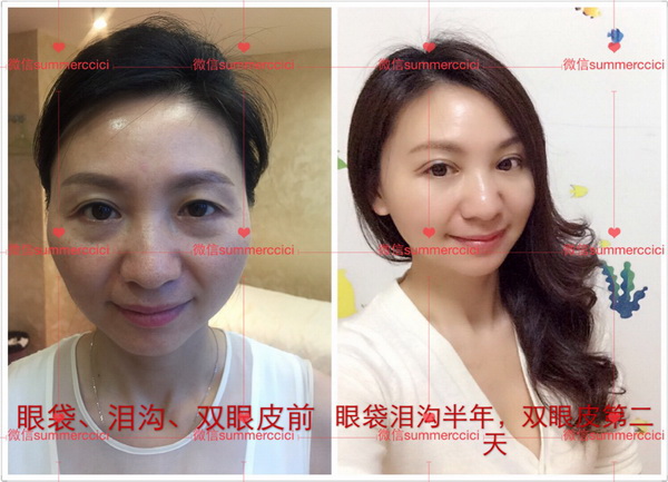 印第安纹|印第安纹怎么改善