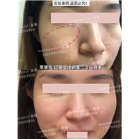 印第安纹苹果肌剥离2次后效果 
