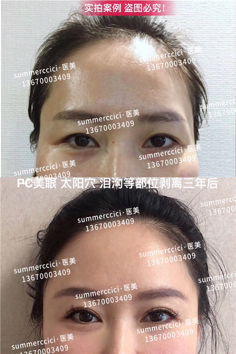 太阳穴剥离3年后 