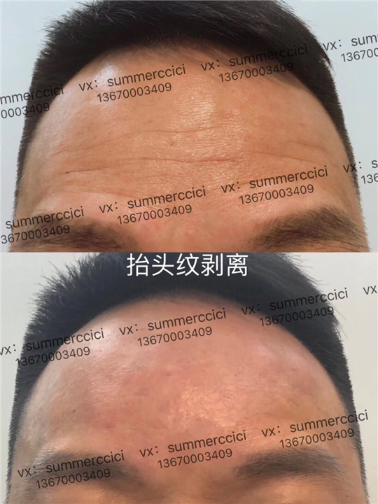 抬头纹剥离 