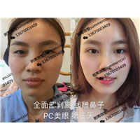 全脸剥离1年后 