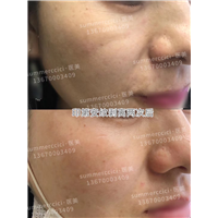 印第安纹剥离2次后 