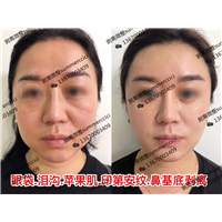 印第安纹剥离1年后效果 