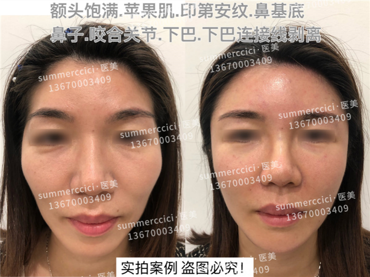 面部多部位剥离即刻效果 