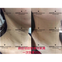 颈纹剥离1次效果 