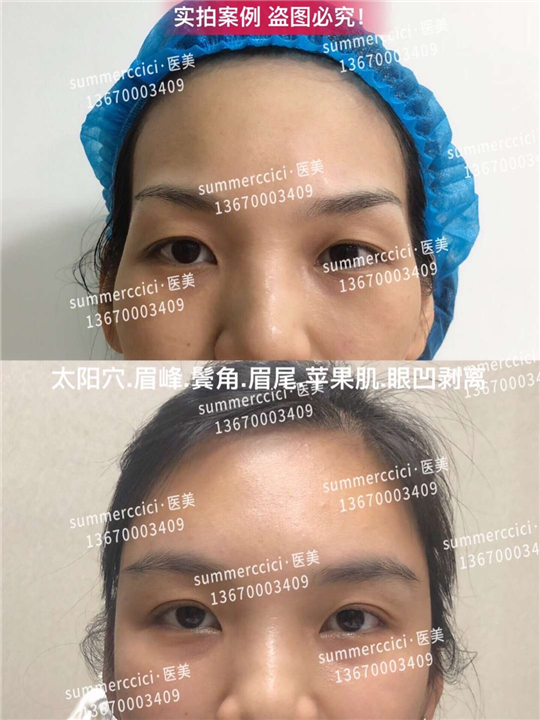 太阳穴眉峰剥离半年 