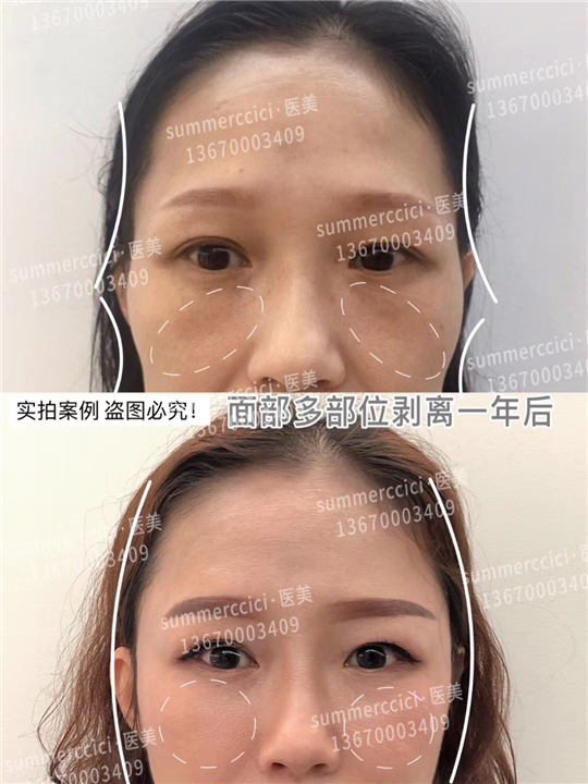 印第安纹剥离一年后 