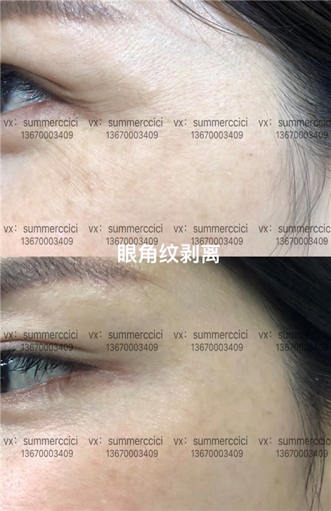 眼角纹剥离2次后 