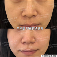 印第安纹苹果肌剥离 