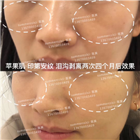 印第安纹剥离2次后 