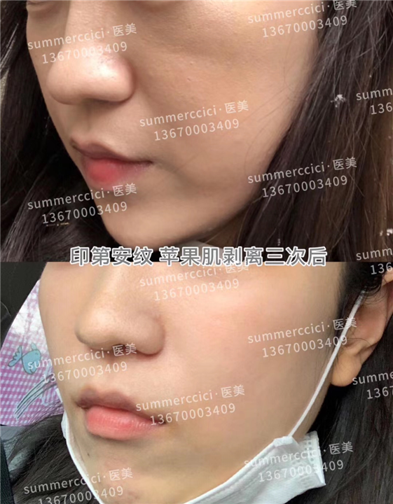 印第安纹剥离3次后 