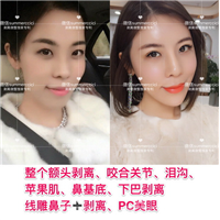 印第安纹祛除|印第安纹去除