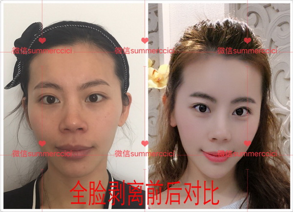 印第安纹|印第安纹怎么改善